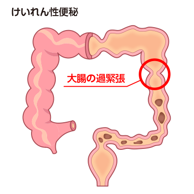 大腸の過緊張